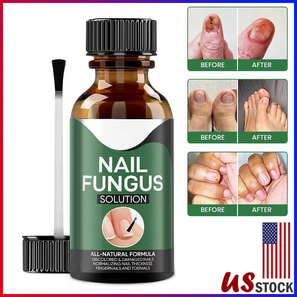 Anti Fungal Nail Treatment Onychomycosis Remover