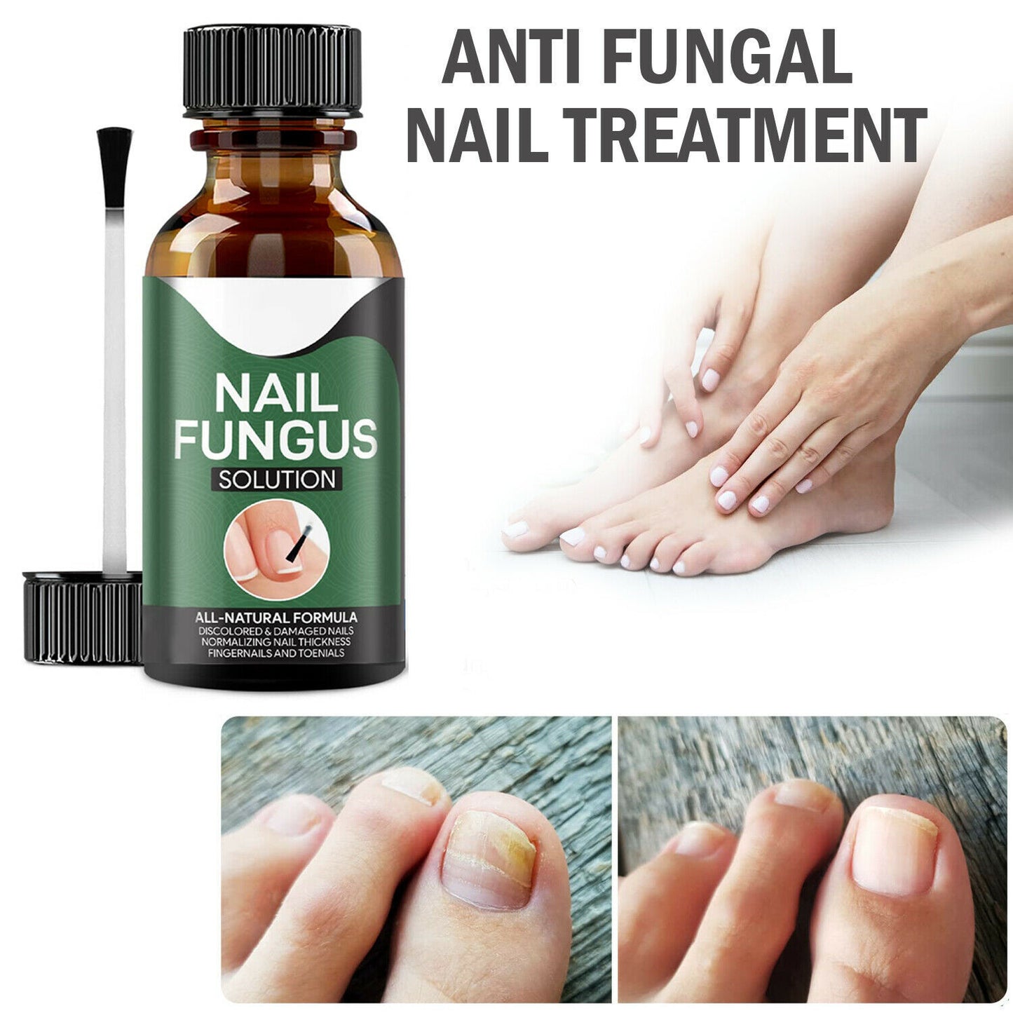 Anti Fungal Nail Treatment Onychomycosis Remover